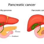 Duct- to -mucosa pancreaticojejunostomy part 2