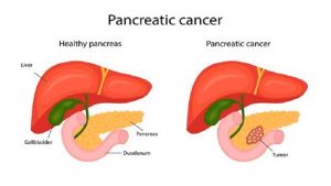 Duct- to -mucosa pancreaticojejunostomy part 2