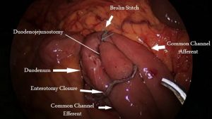 Duodenojejunostomy