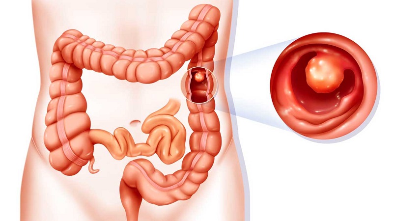 Right hemicolectomy - عمل جراحی کولکتومی راست