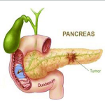 رزکسیون سر پانکراس