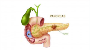 رزکسیون سر پانکراس
