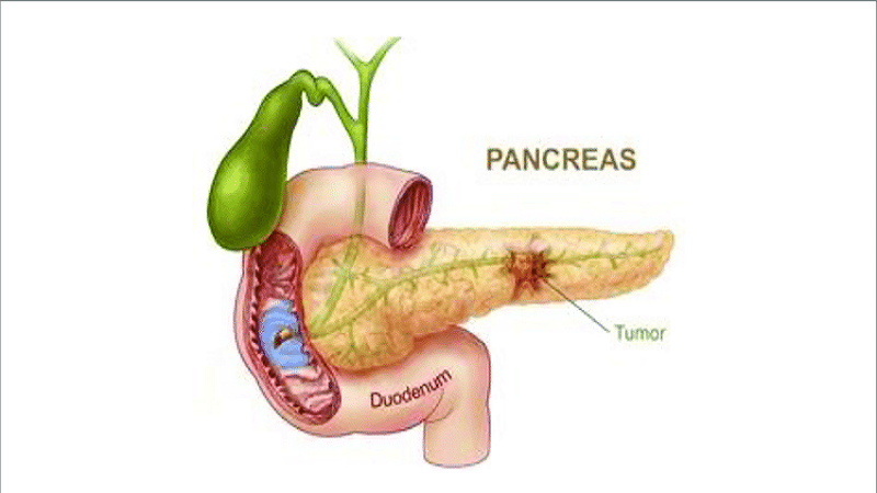رزکسیون سر پانکراس